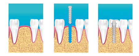 Implants dentaires Champs-sur-Marne